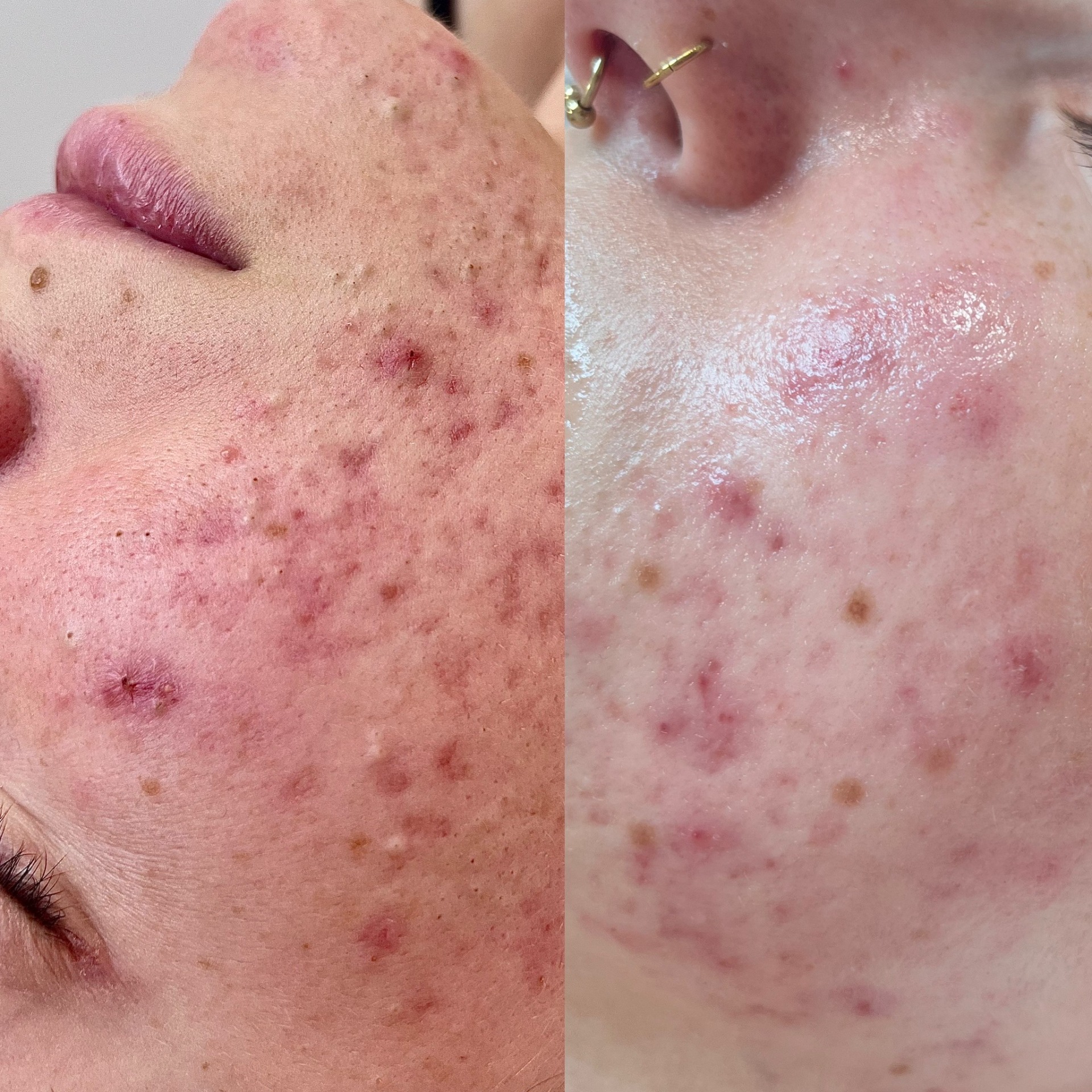 rozdíl po jednom ošetření