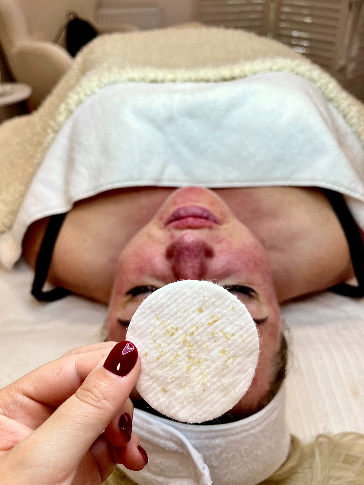 Akné i po 3Occe? To teda ne. Hned jsme s tím něco udělali a pleť po prvním ošetření zářila. Klientka se již těší na další, protože i po týdnu má stále krásnou a čistou pleť. Pomalu se zbavujeme hlavně zánětů a rozšířených porů.