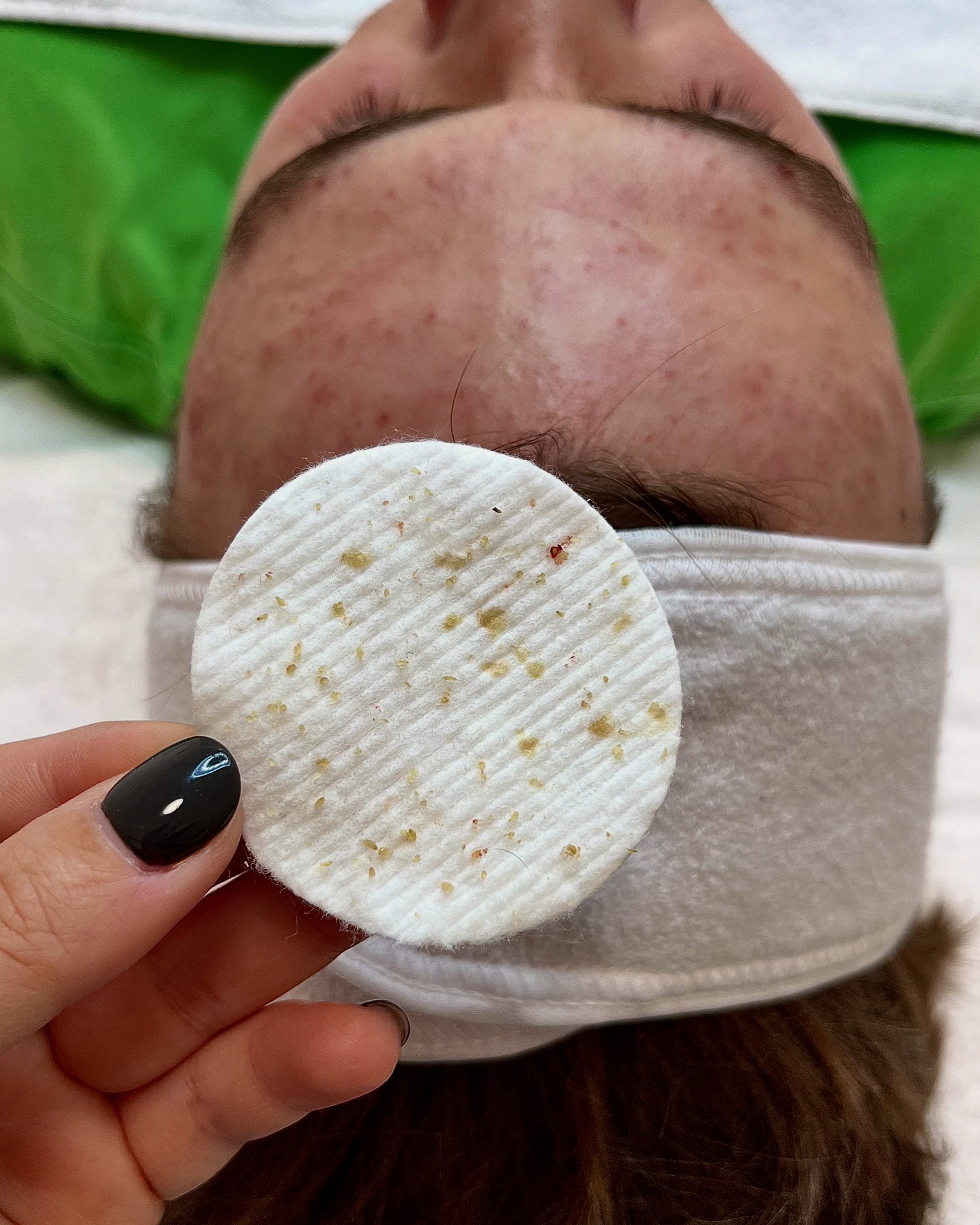 Čištění pleti 14ti letého chlapce v pubertě. Hormony, pot, testosteron, špatné mytí obličeje, stud. Vše jsme napravili!